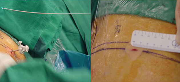 The endoscope tube is only 6mm in diameter, there is no scars after the procedure.
