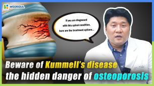 Kummell’s Disease: The Spinal Fracture You Should Never Ignore