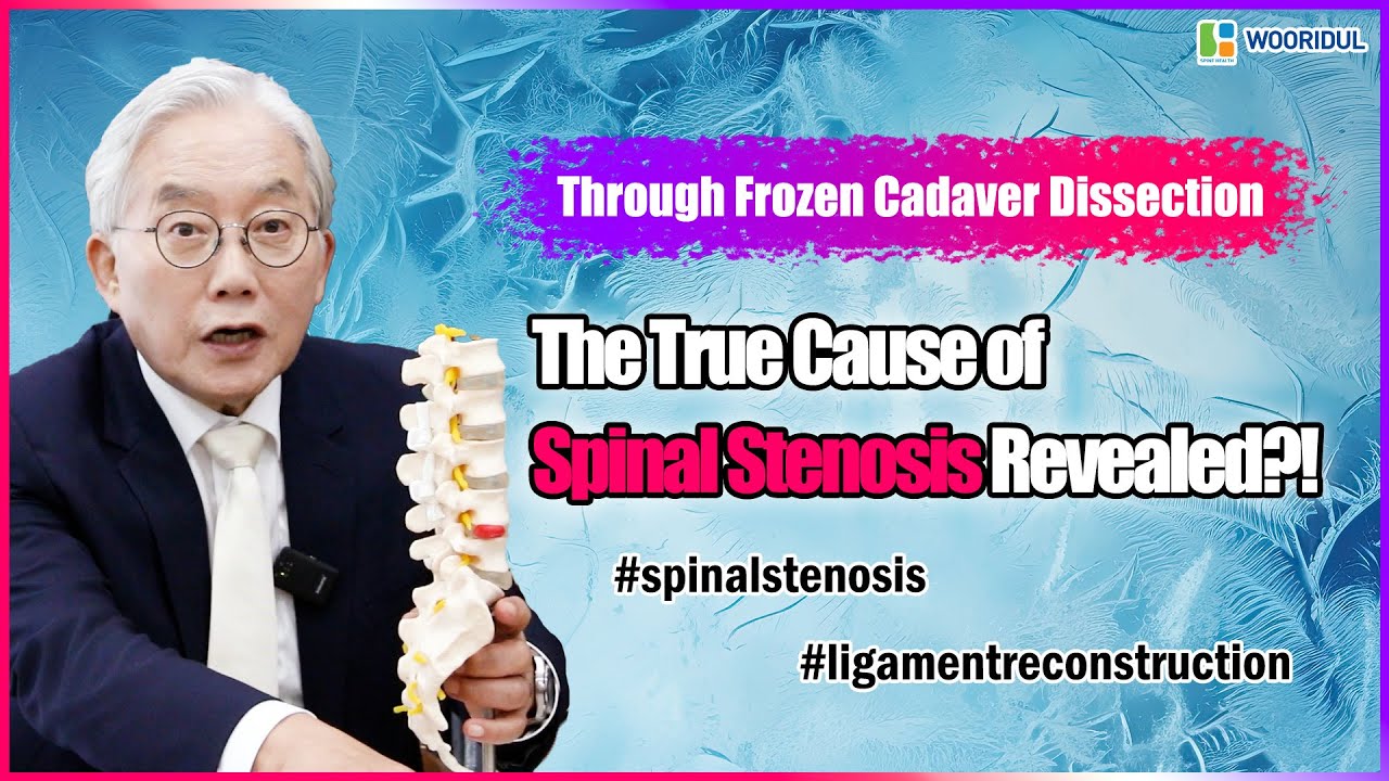  The True Cause of Spinal Stenosis